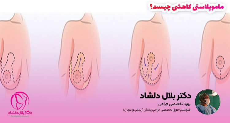 ماموپلاستی کاهشی یا جراحی کوچک کردن سینه